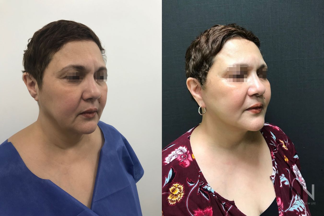 Before and after mini facelift and neck lift six months results - Angle 4