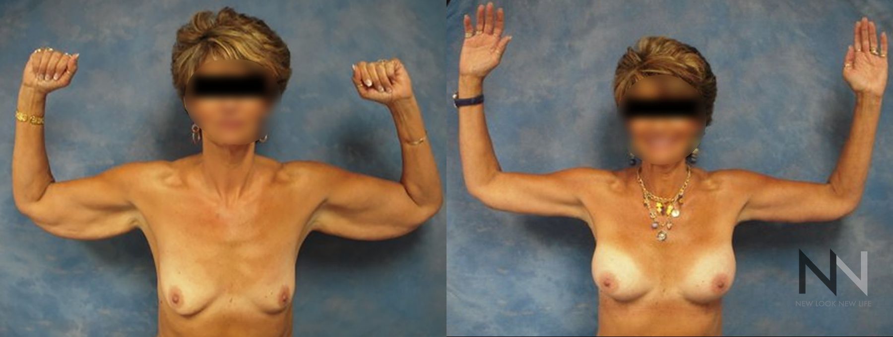 Before and after arm lift and breast augmentation results