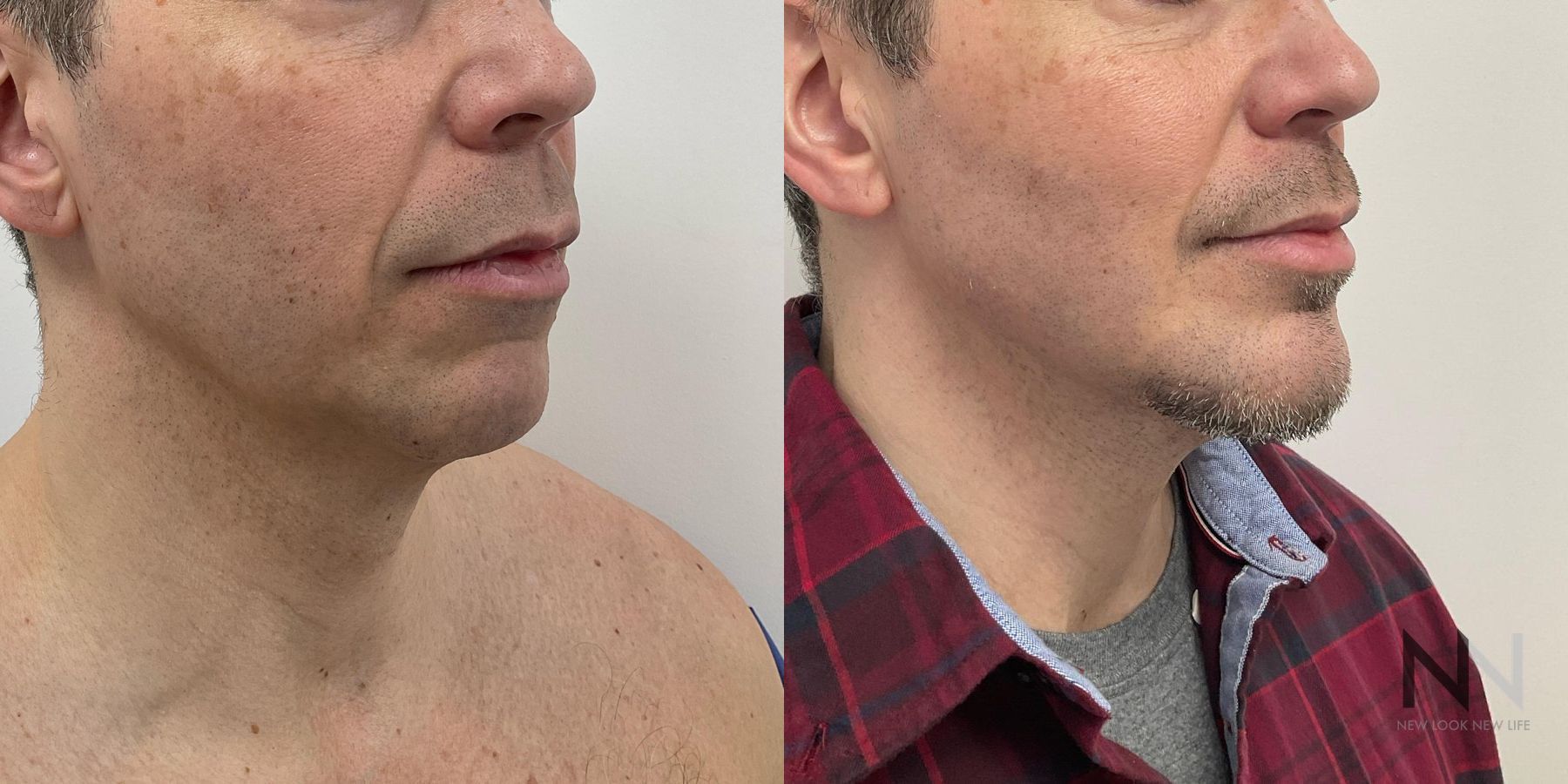 Jawline definition improvement after chin augmentation - Angle 2