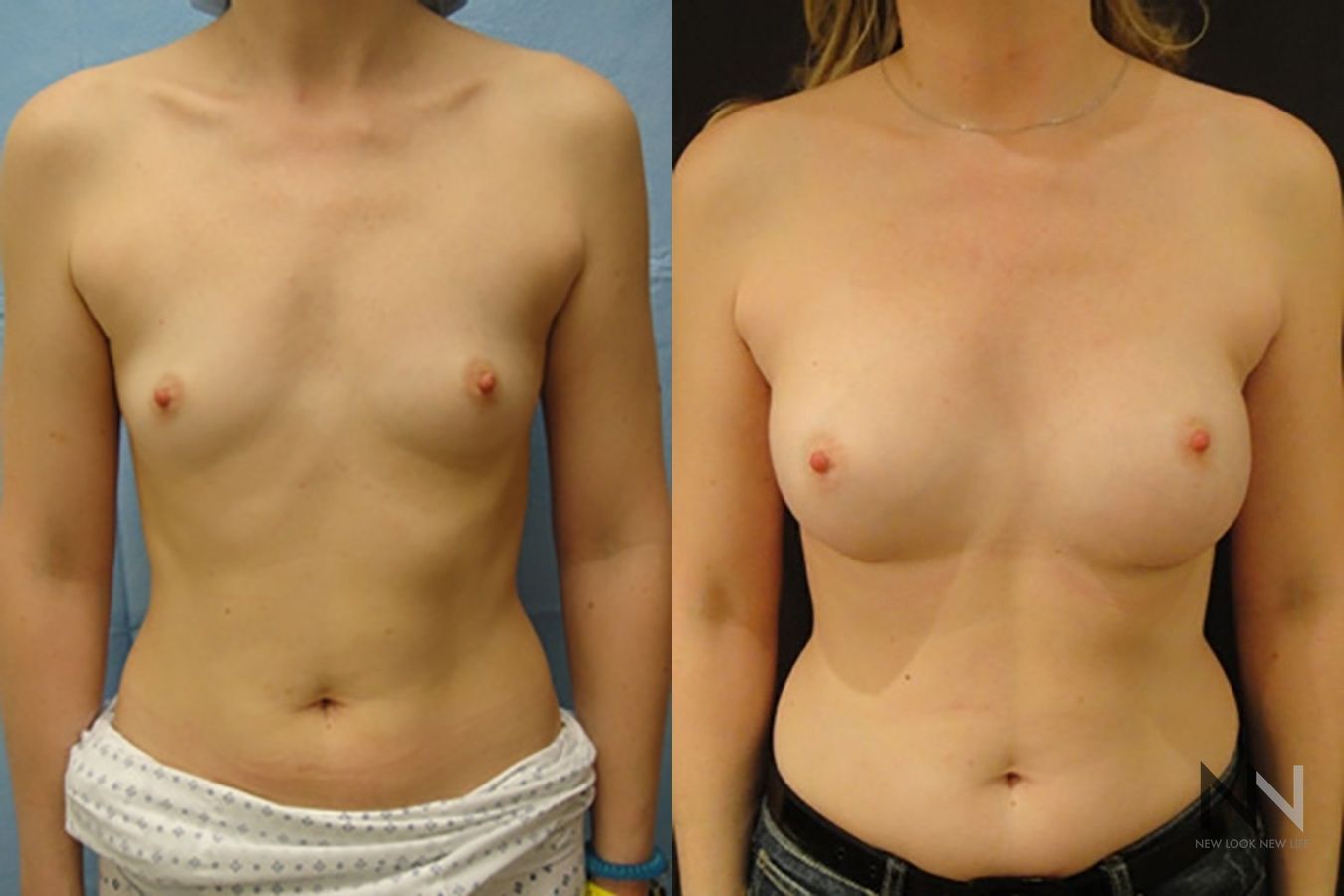 Breast augmentation before and after symmetry improvement