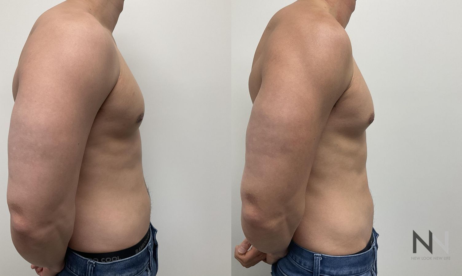 Gynecomastia surgery showing flatter chest contour - Angle 5