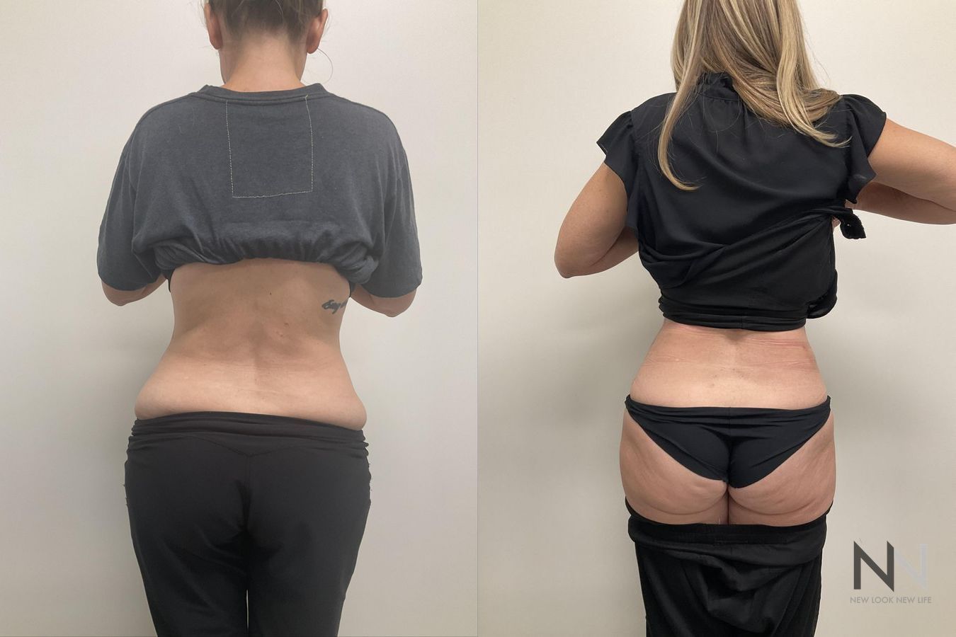 Waistline definition after abdominoplasty procedure - Angle 2