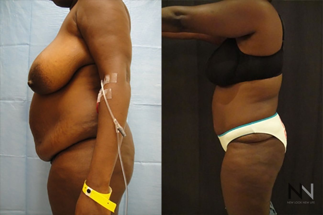 Abdominoplasty showing flatter abdomen and tighter skin - Angle 2