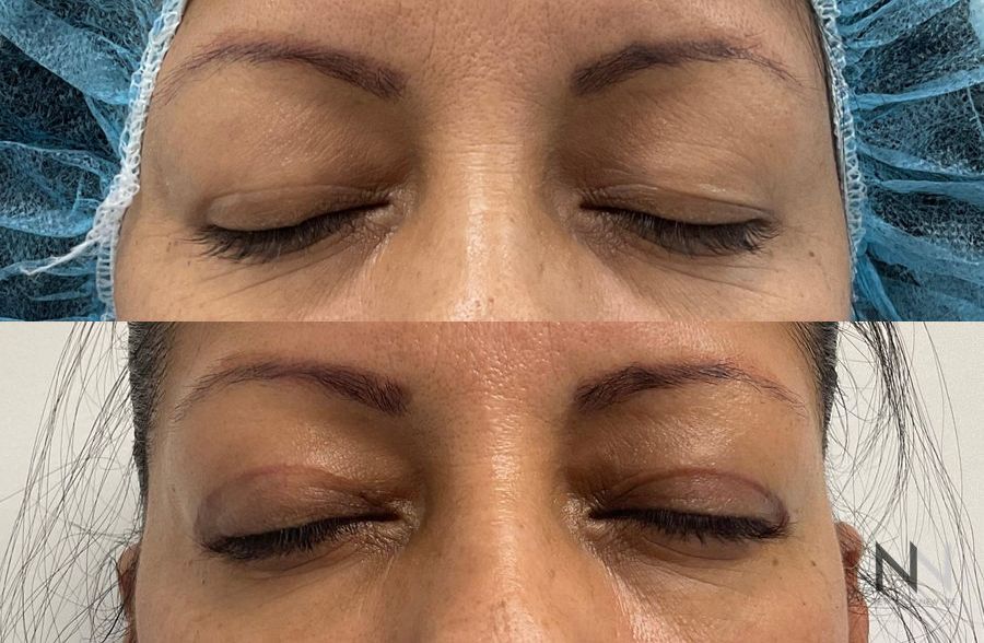 Upper blepharoplasty before and after eyelid contour improvement - Angle 2
