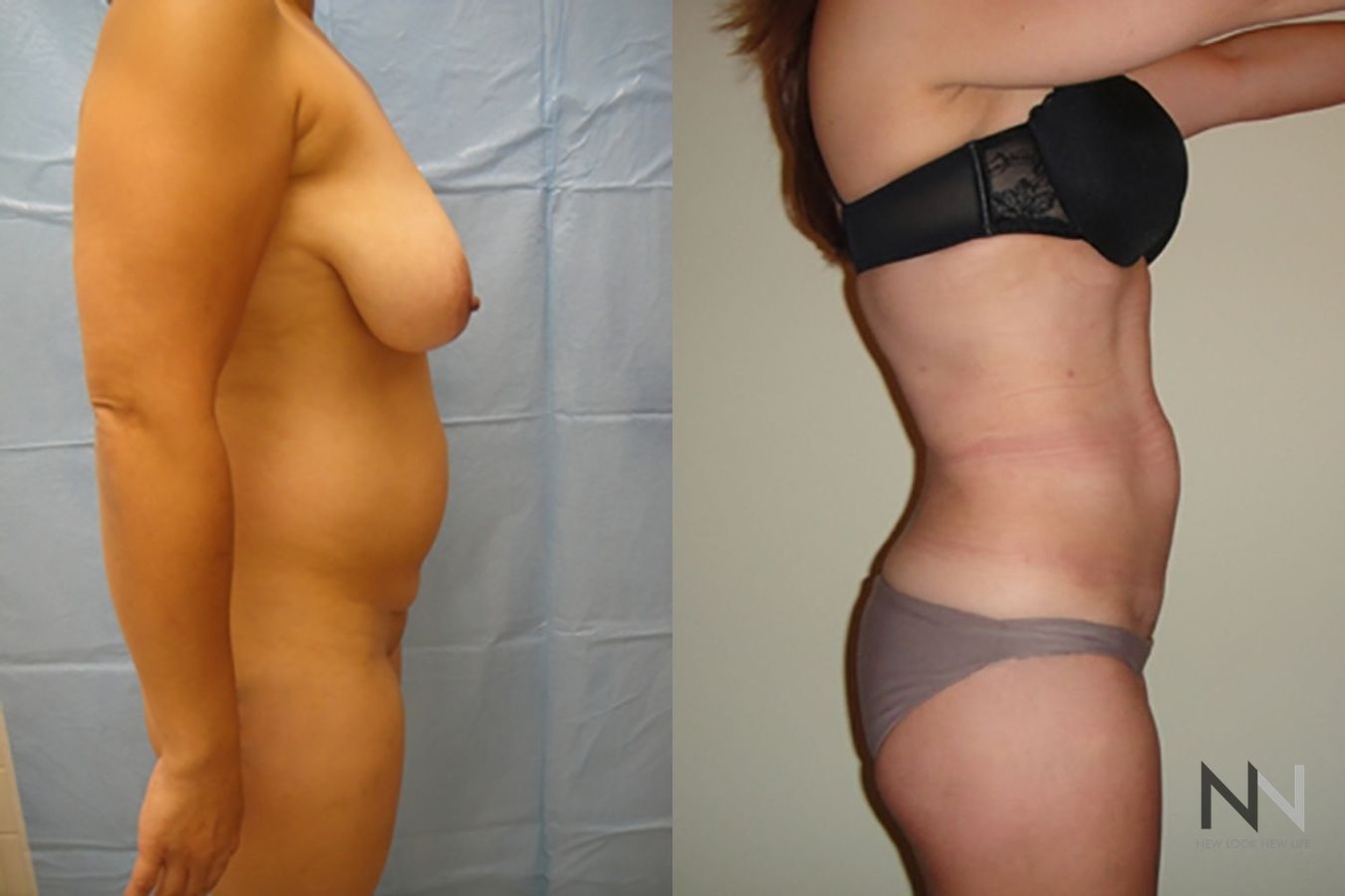 Before and after liposuction six months results - Angle 3