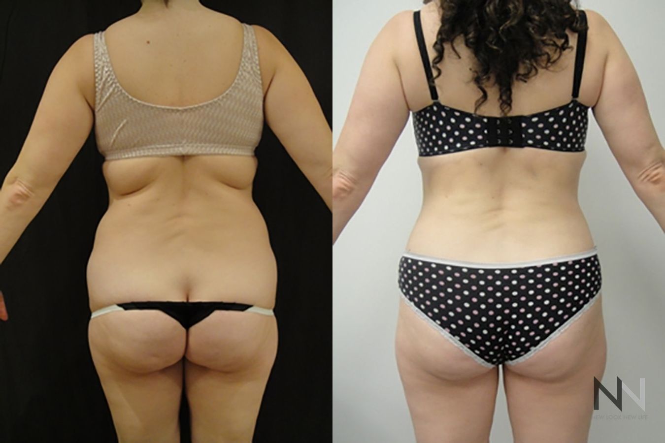 Before and after TICKLE liposuction flanks six months results - Angle 4