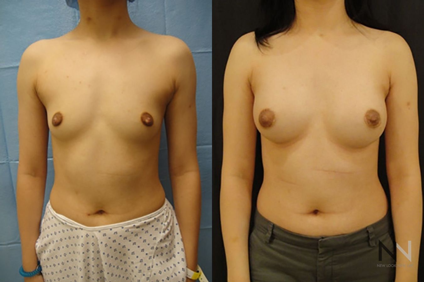 Breast augmentation results with improved projection