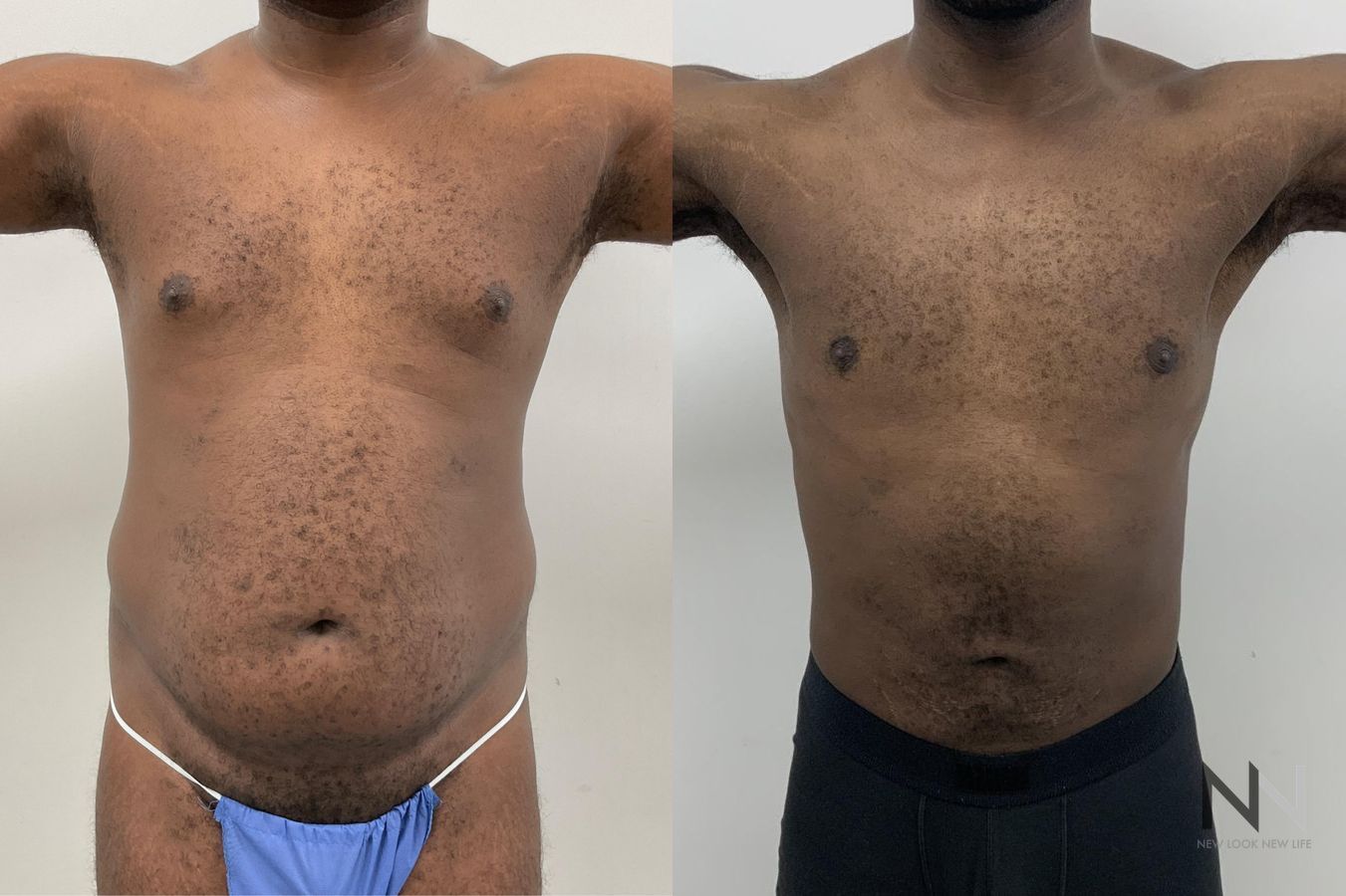 Body contouring with liposuction before and after - Angle 2