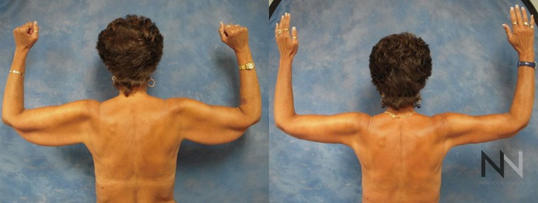Before and after arm lift and breast augmentation results - Angle 2