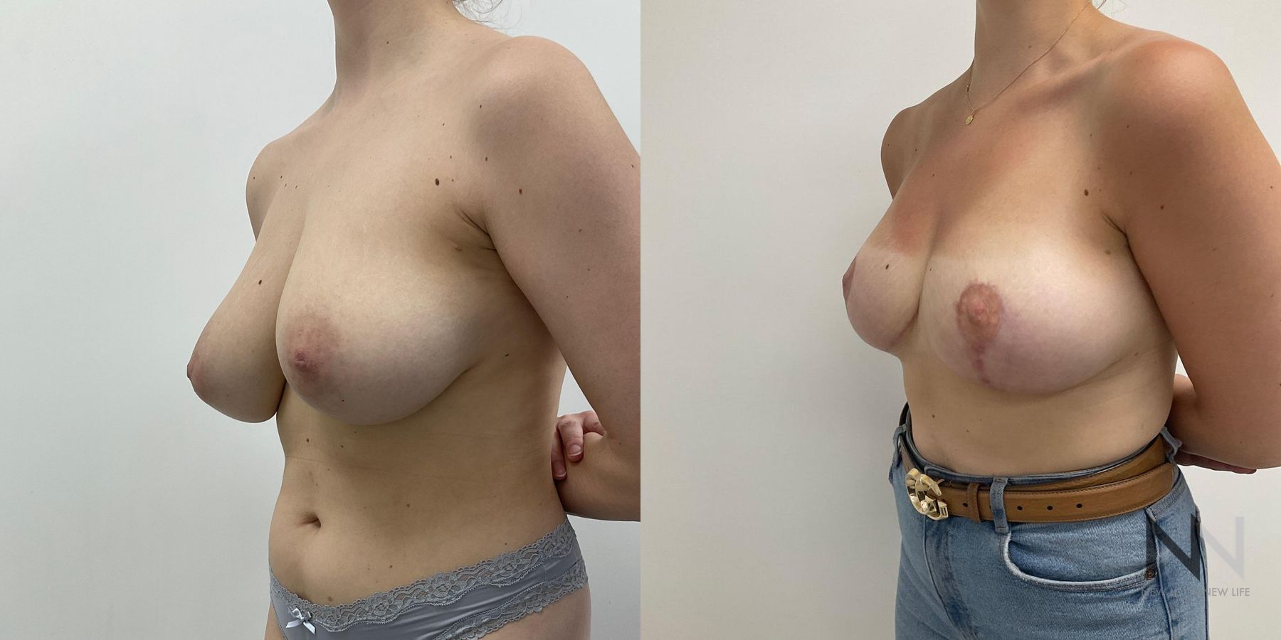 Reduction mammoplasty showing improved breast contour - Angle 3