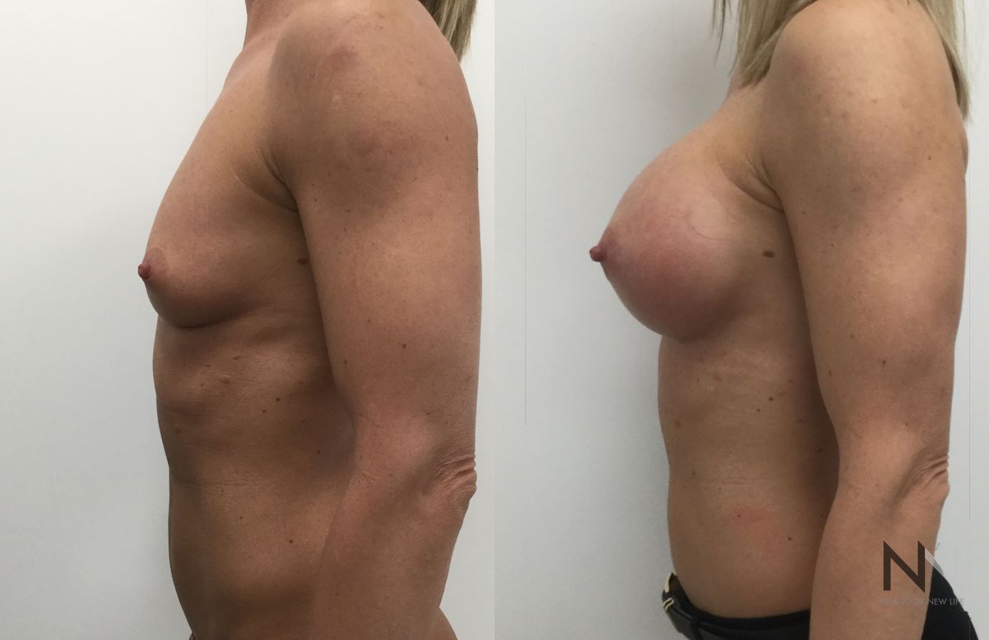 Breast implants showing increased volume and projection - Angle 2