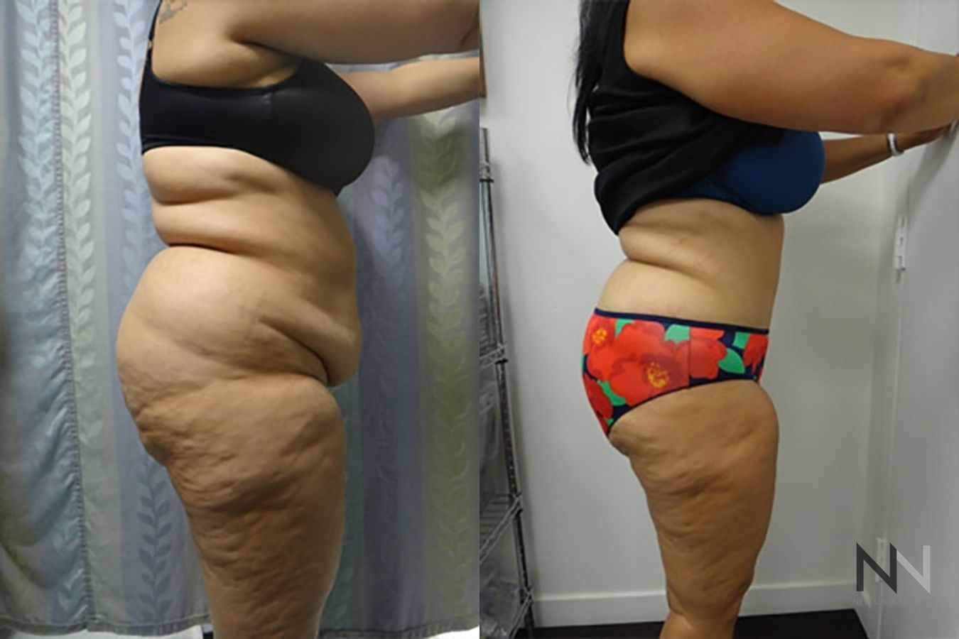 Before and after tummy tuck eight months results - Angle 3