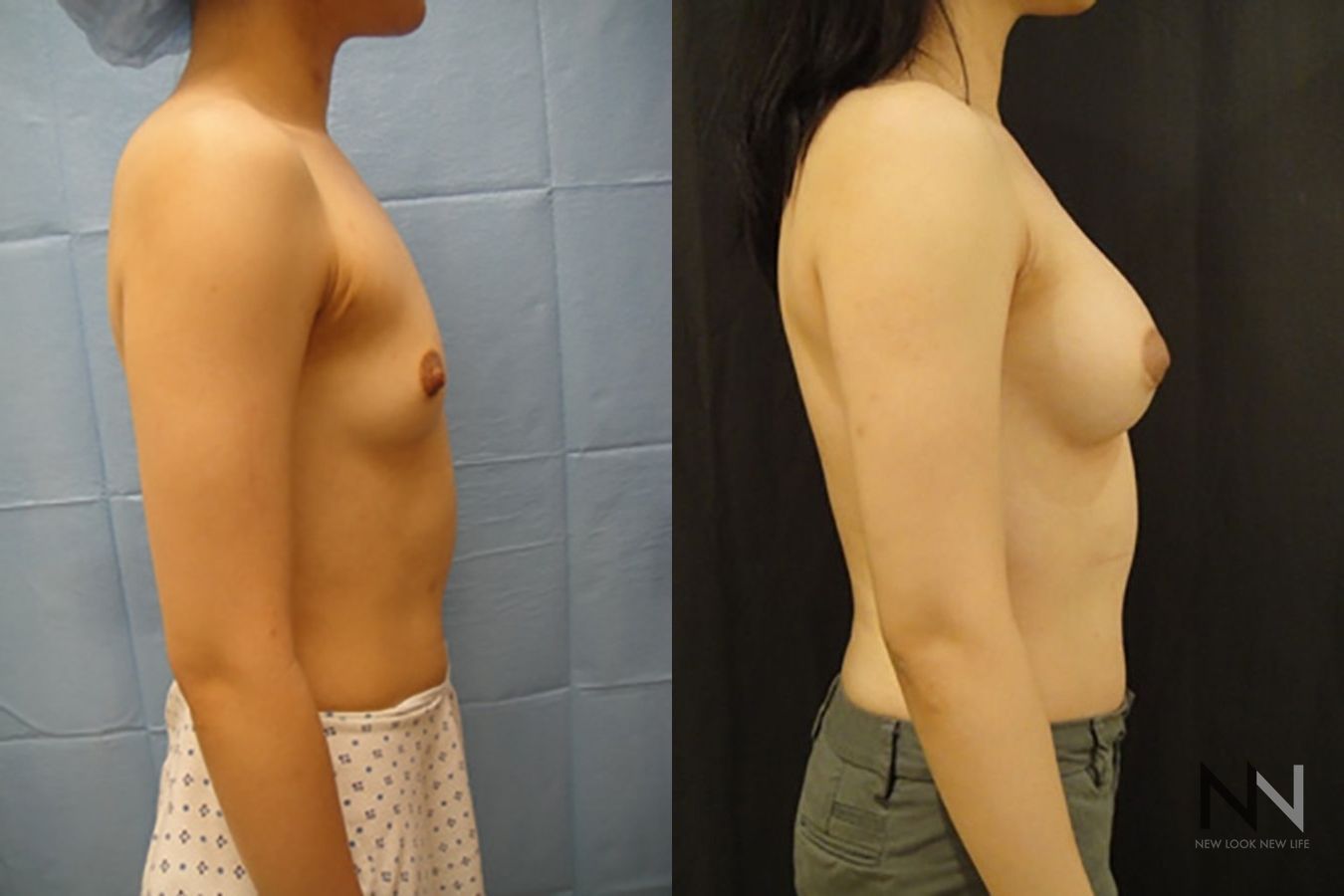 Breast augmentation results with improved projection - Angle 5