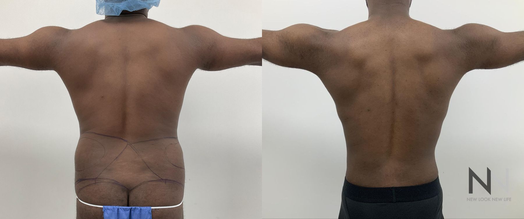 Body contouring with liposuction before and after - Angle 5