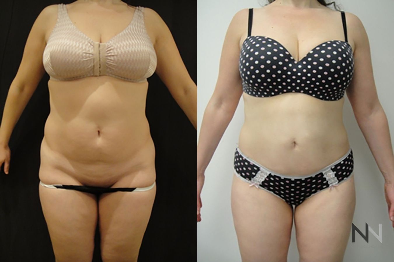 Before and after TICKLE liposuction flanks six months results