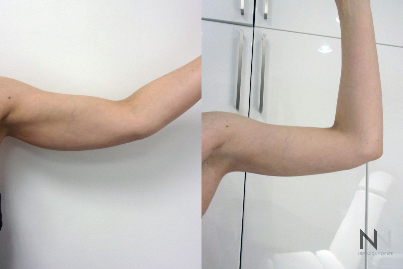 Before and after arm liposuction six months results - Angle 2