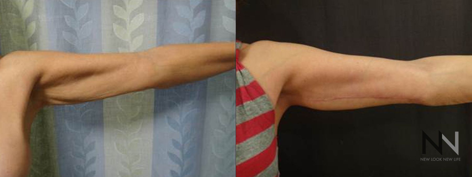 Before and after arm lift six months results - Angle 2