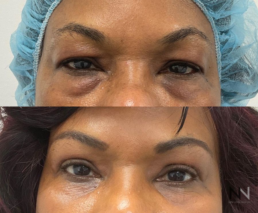 Before and after upper and lower blepharoplasty three months results - Angle 2