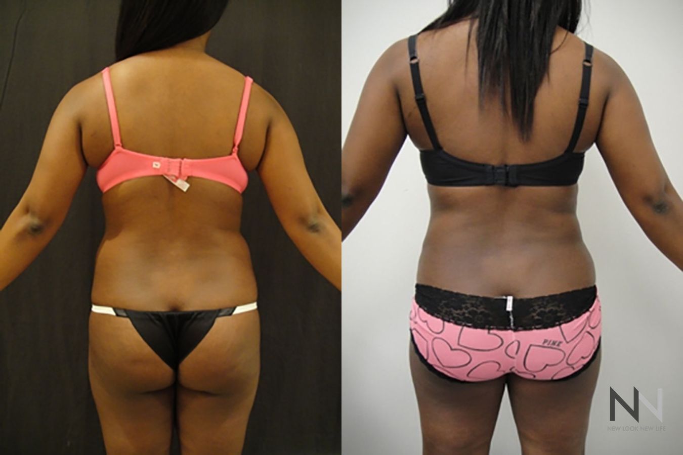Liposuction 360 showing improved waistline definition - Angle 4