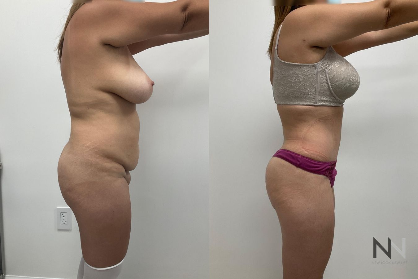 Abdominoplasty results showing improved abdominal contour - Angle 4