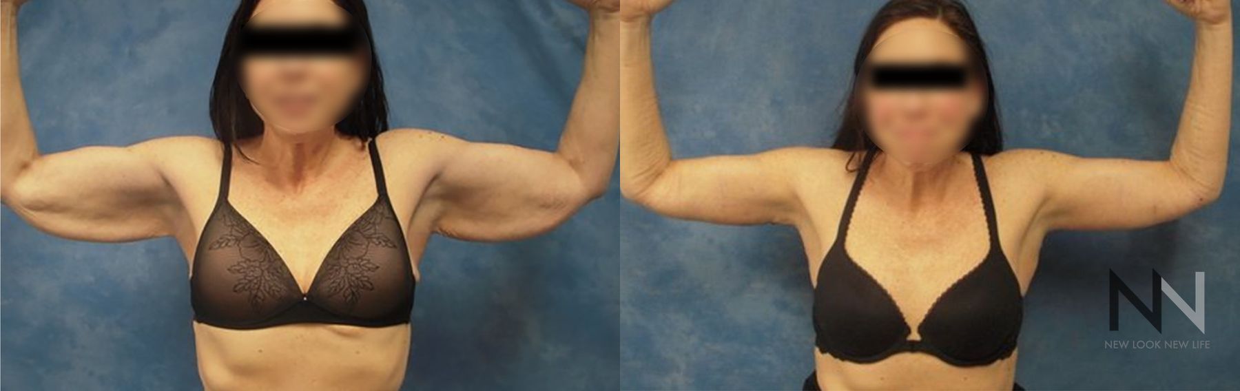 Before and after arm lift six months results