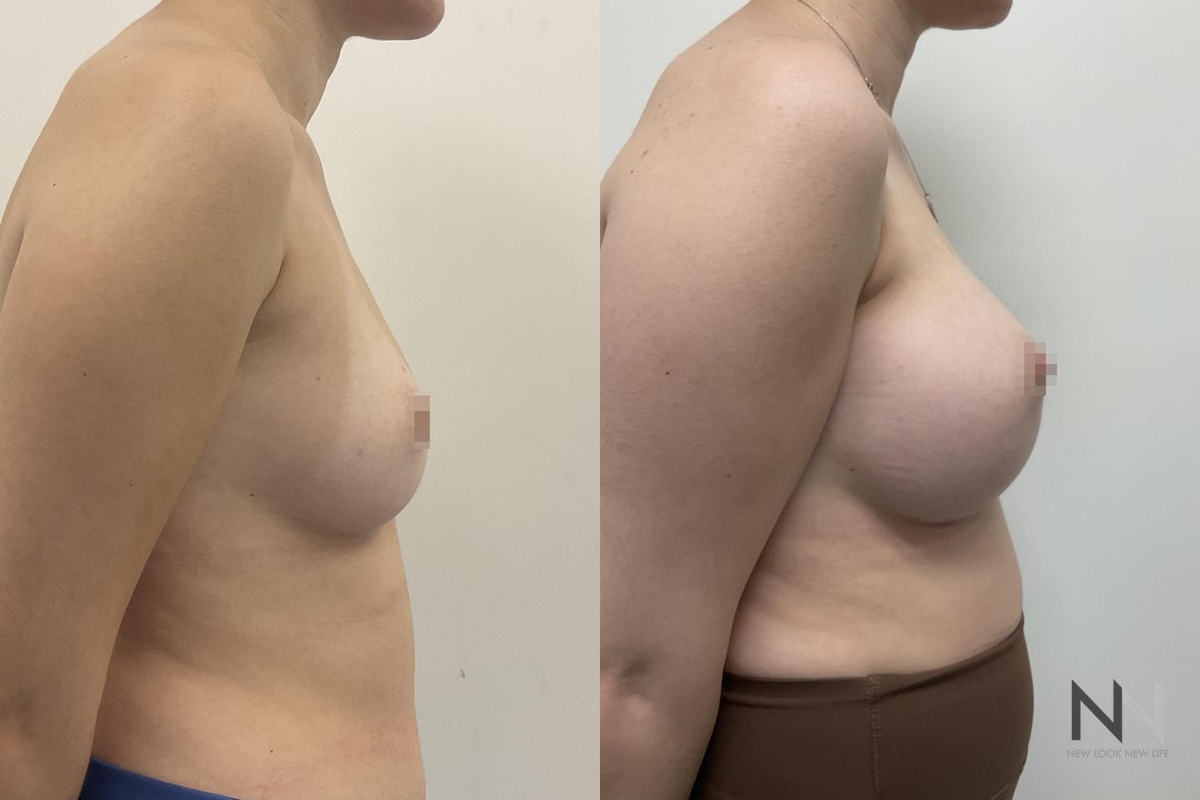 Before and after breast augmentation saline implants six months - Angle 5