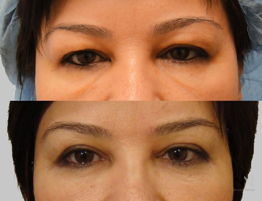 Before and after facial fat grafting under-eye volume
