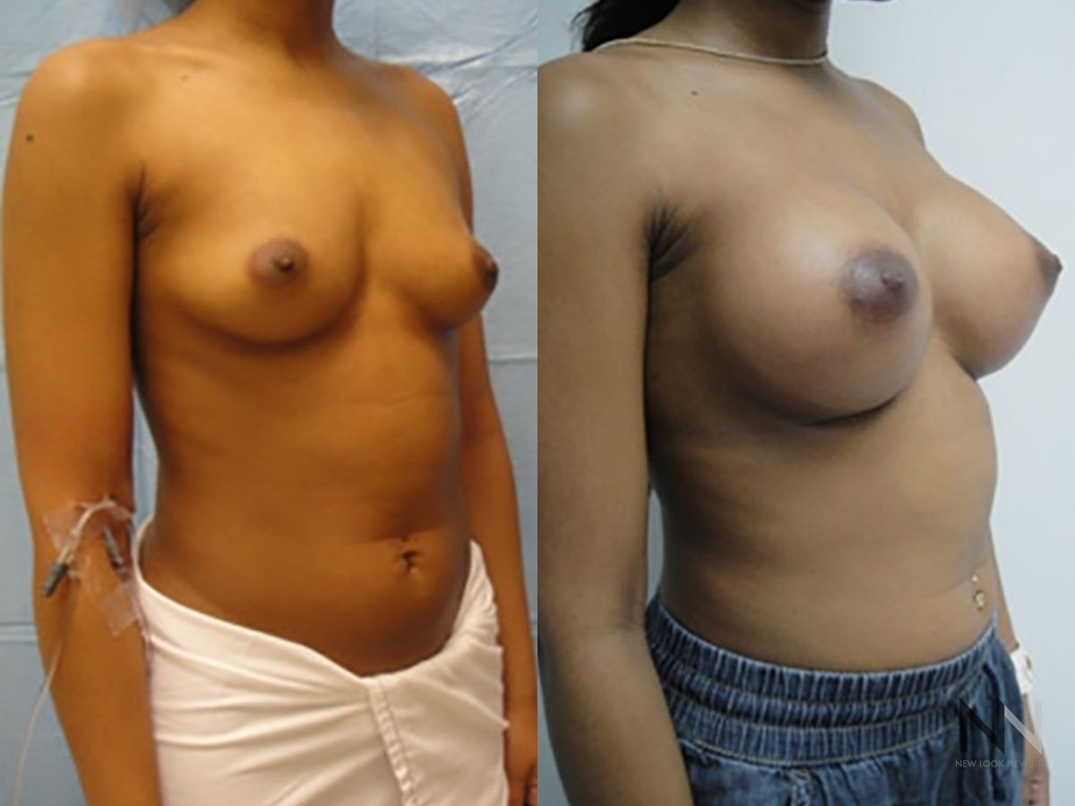 Breast implants showing increased volume and projection - Angle 4