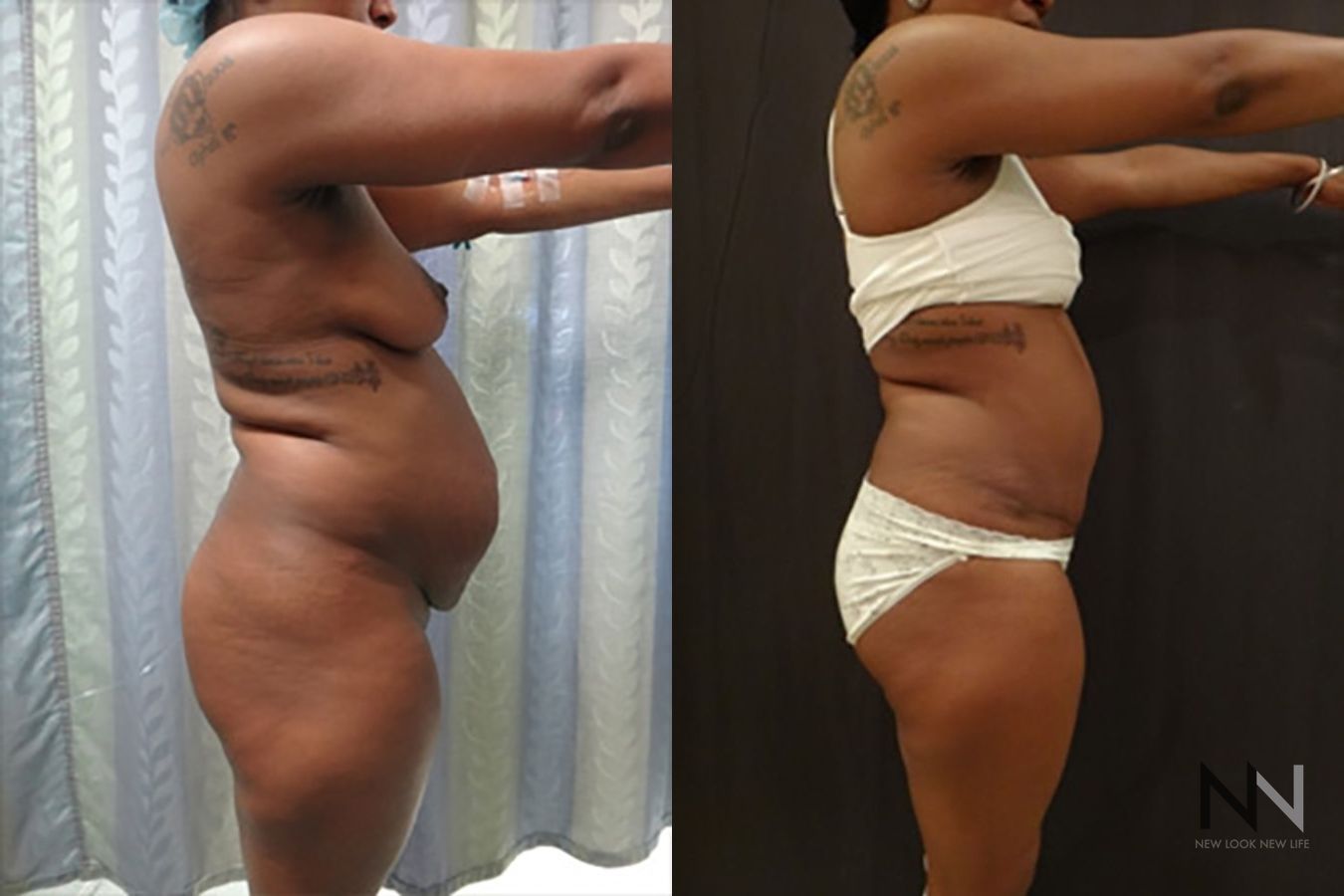 Tummy tuck before and after abdominal contour improvement - Angle 3