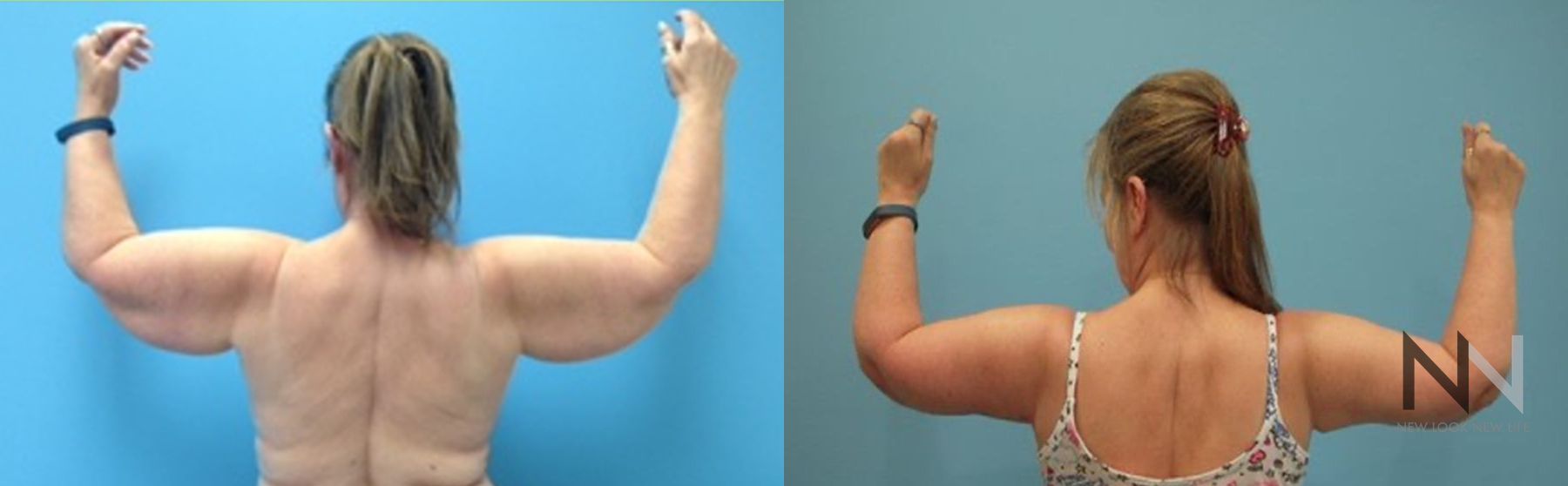 Upper arm tightening after brachioplasty surgery - Angle 2