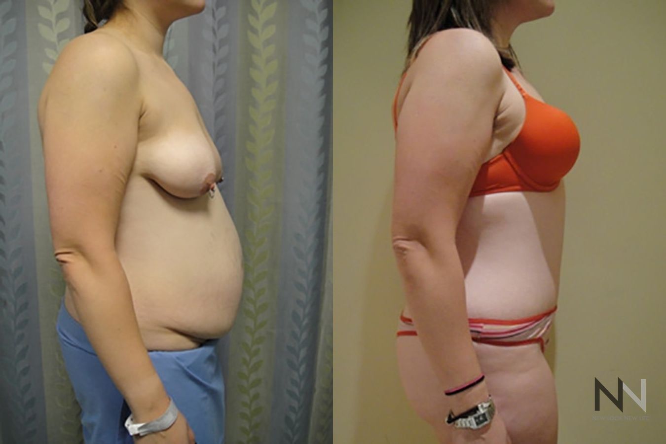 Before and after tummy tuck eight months results - Angle 3