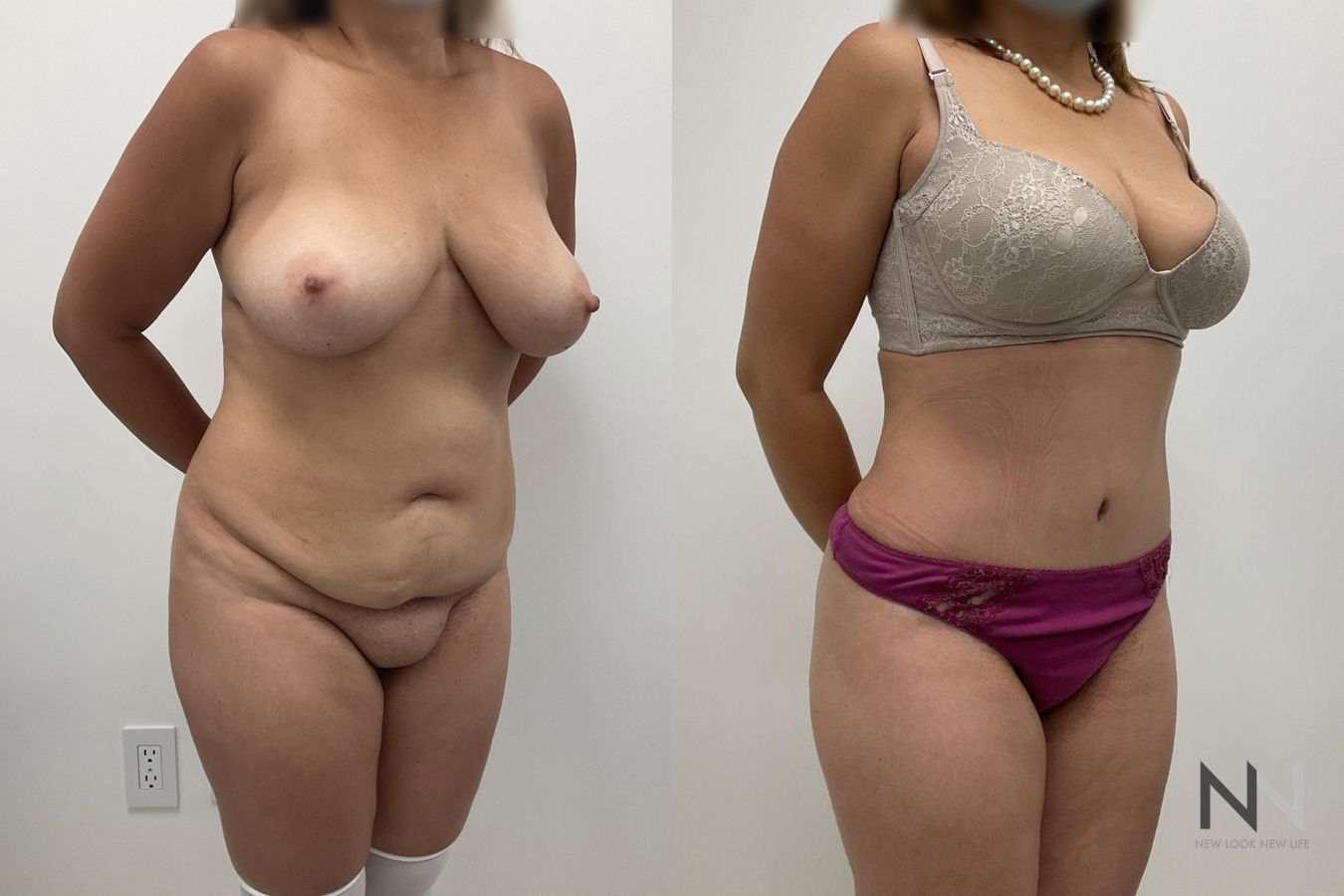 Abdominoplasty results showing improved abdominal contour - Angle 2