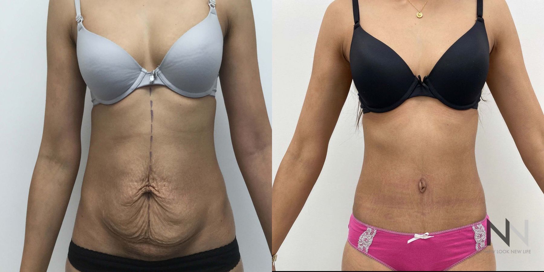 Before and after tummy tuck six months results