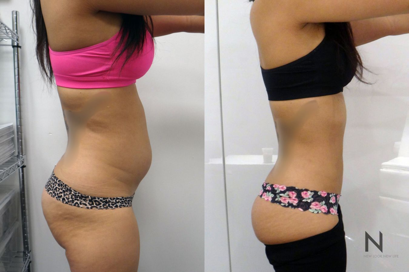 Awake liposuction showing improved waistline contour - Angle 2