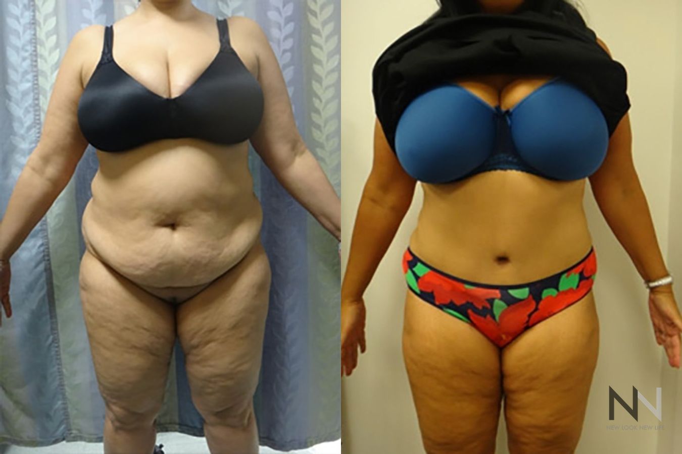 Before and after tummy tuck eight months results