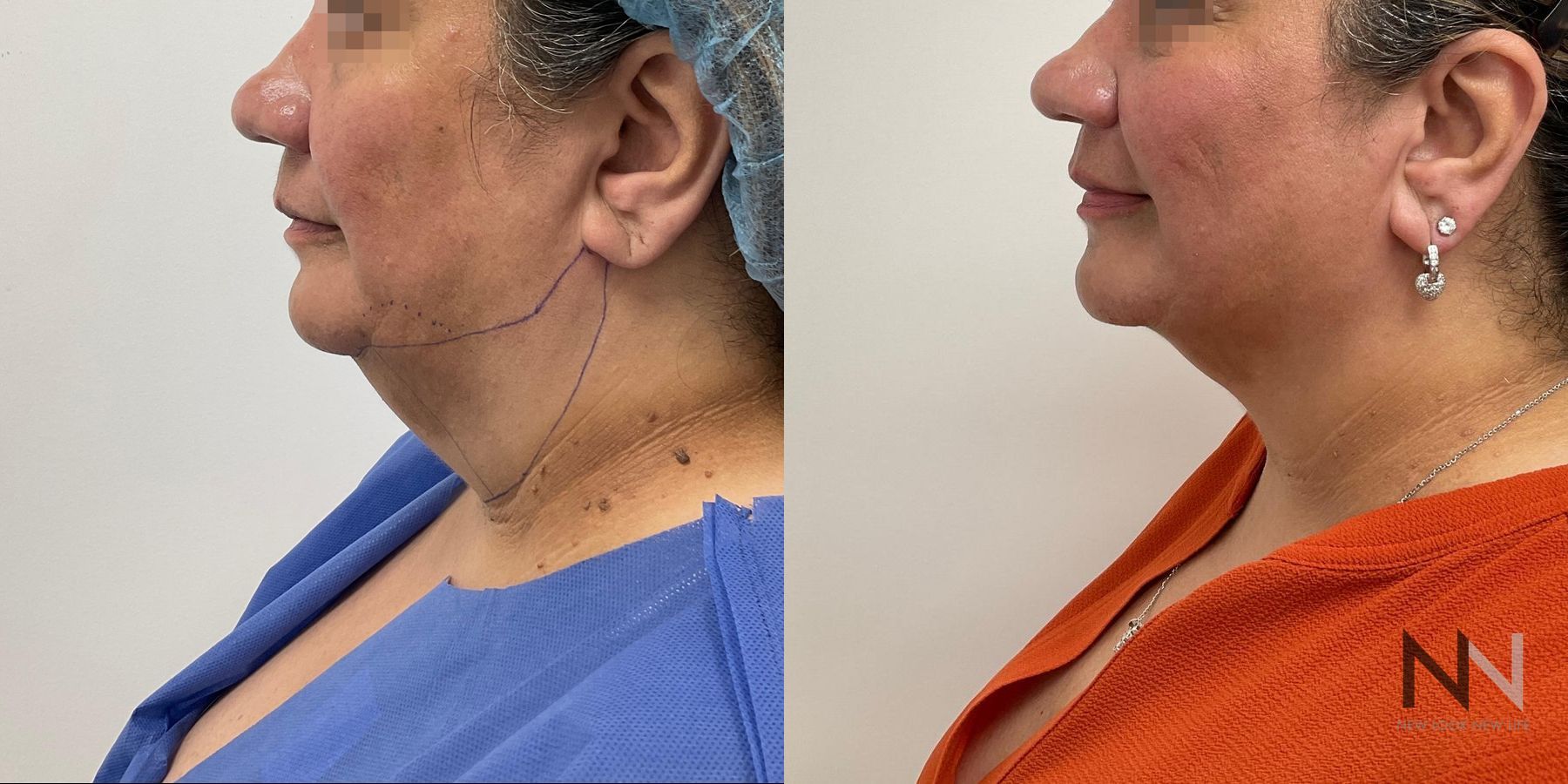 Submental liposuction showing improved jawline contour - Angle 2