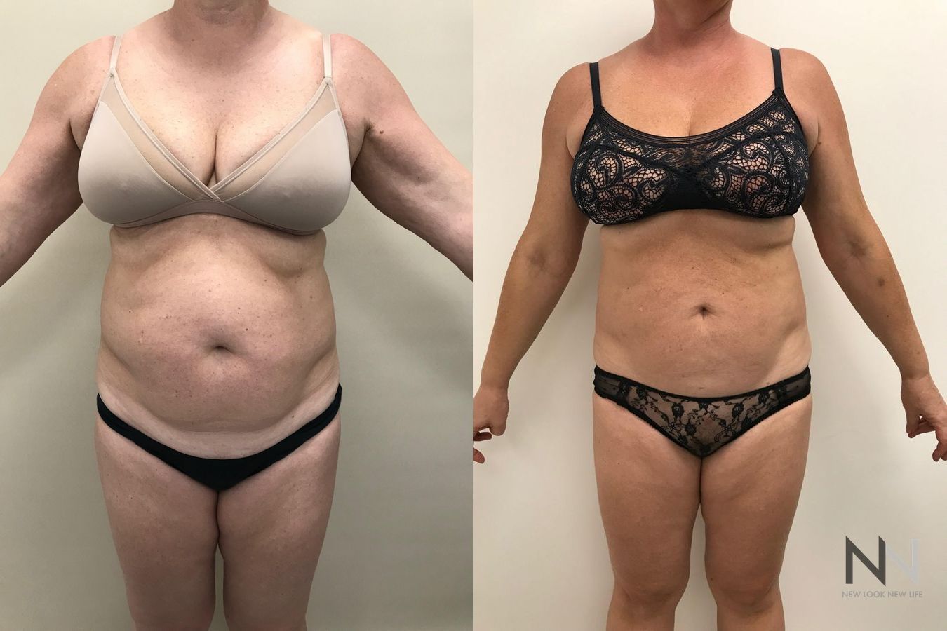 Before and after TICKLE liposuction six months results