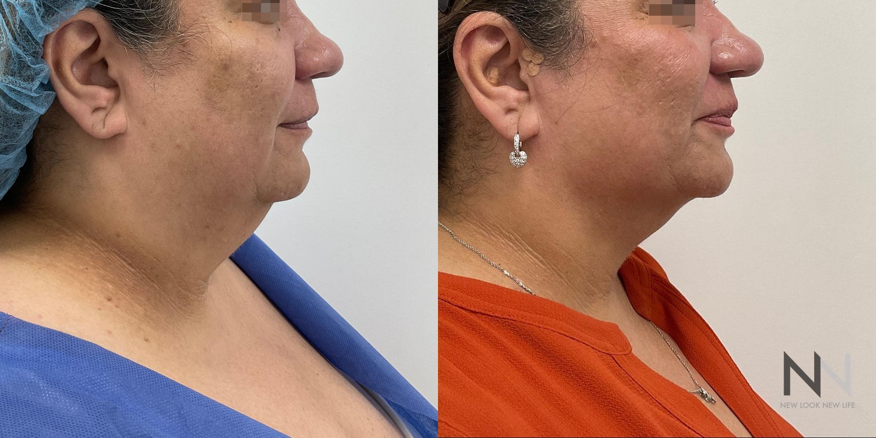Submental liposuction showing improved jawline contour