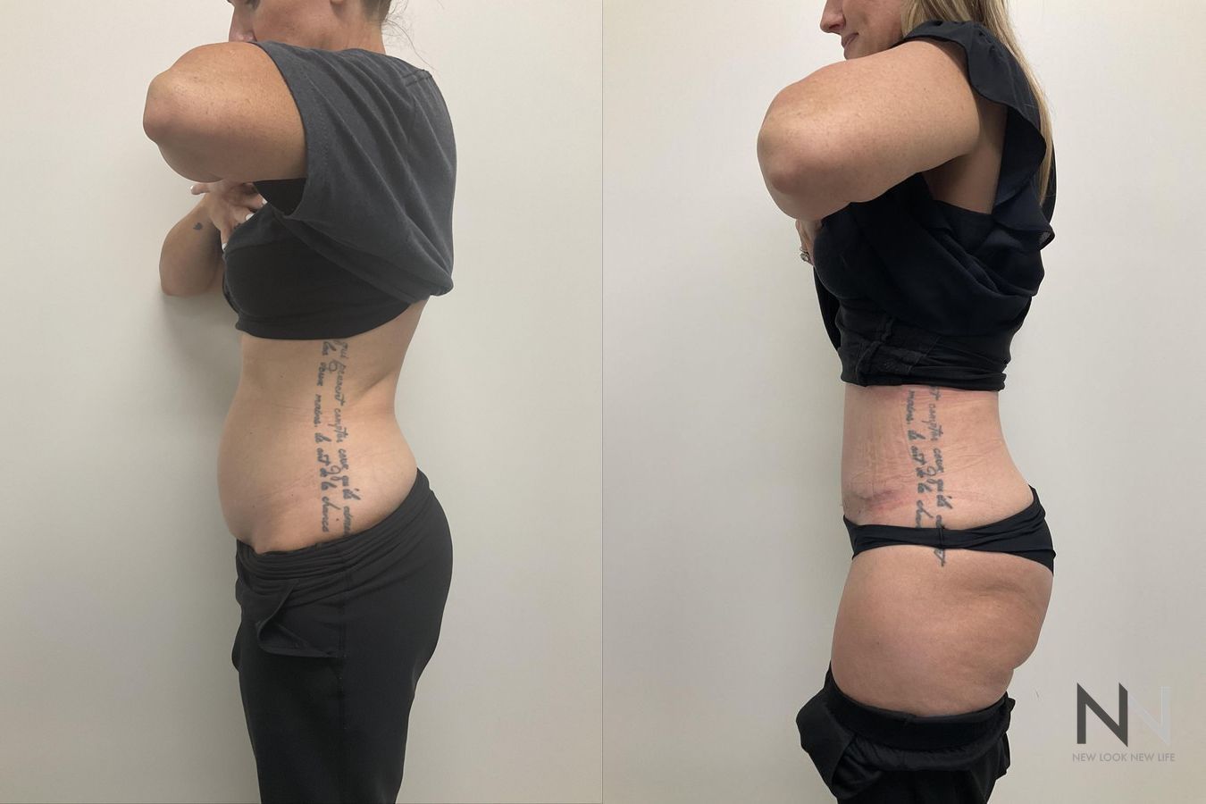 Waistline definition after abdominoplasty procedure - Angle 4