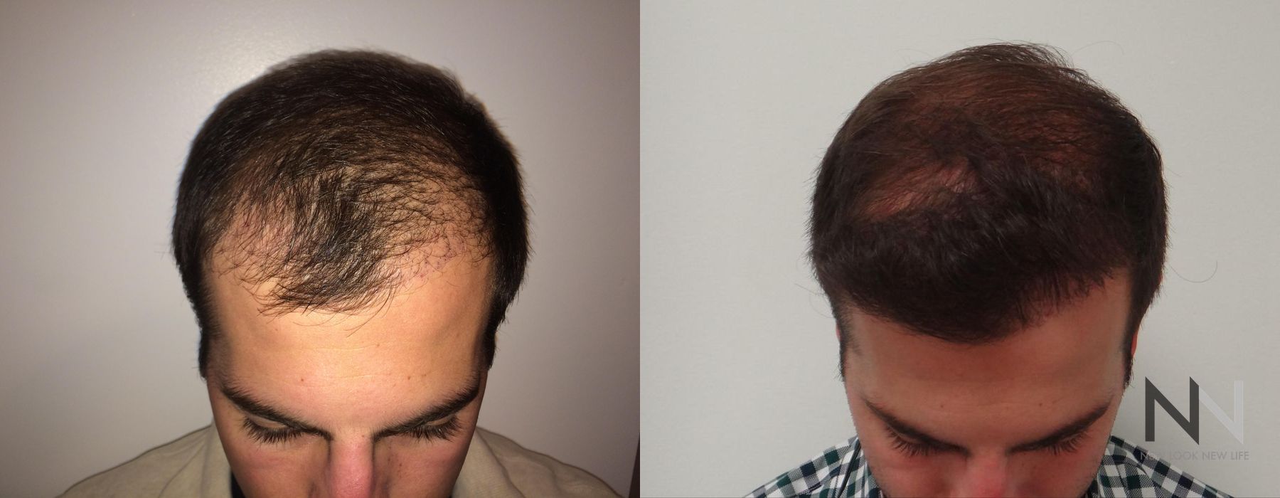 Hair Loss Treatment - Case 323