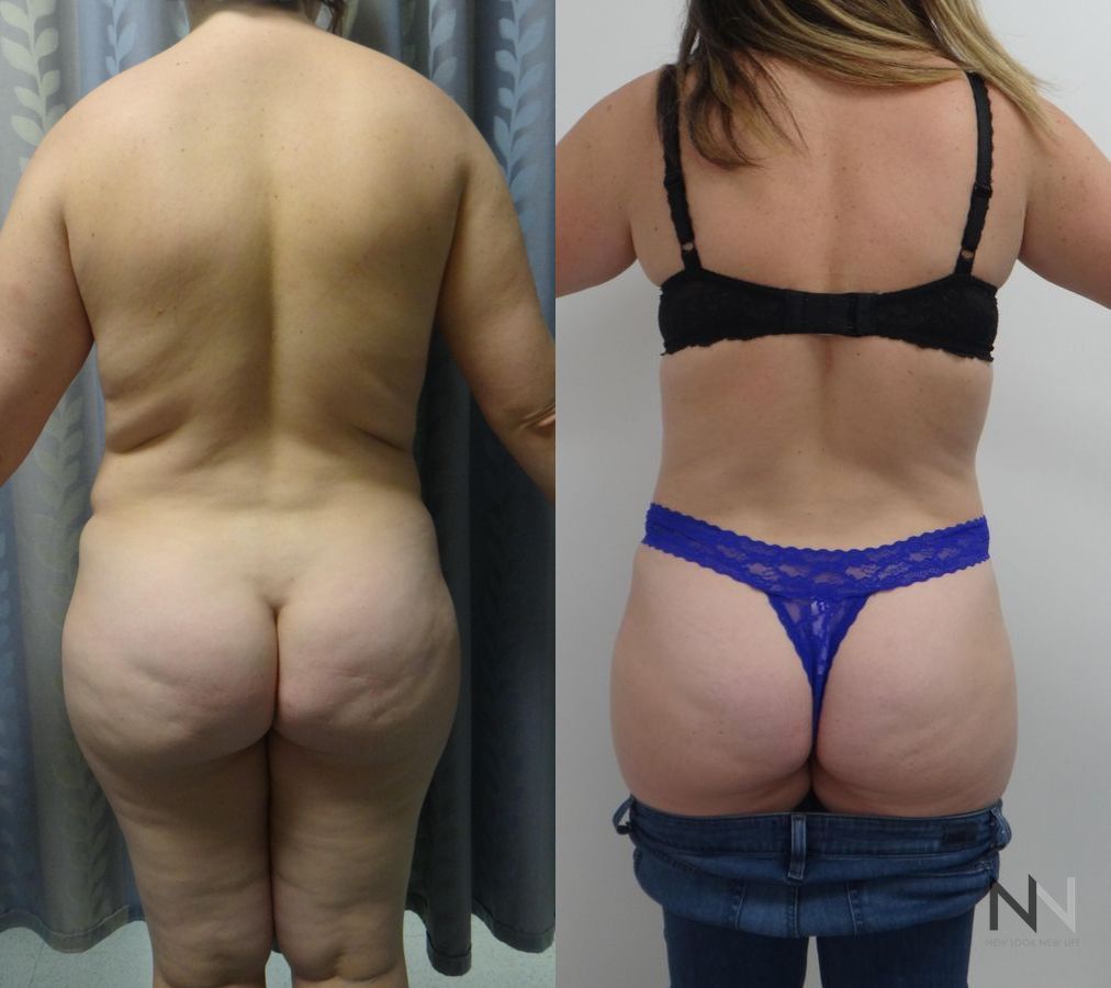 Midsection contour refinement after abdominoplasty - Angle 4