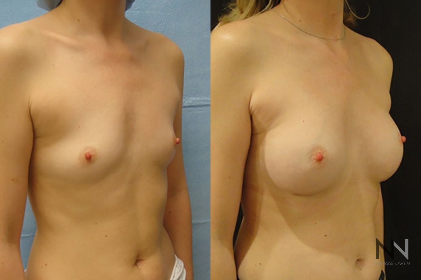 Breast augmentation before and after symmetry improvement - Angle 3