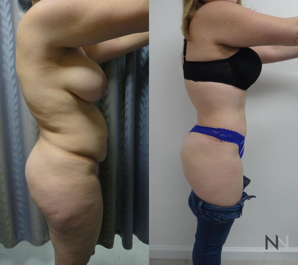 Midsection contour refinement after abdominoplasty - Angle 3