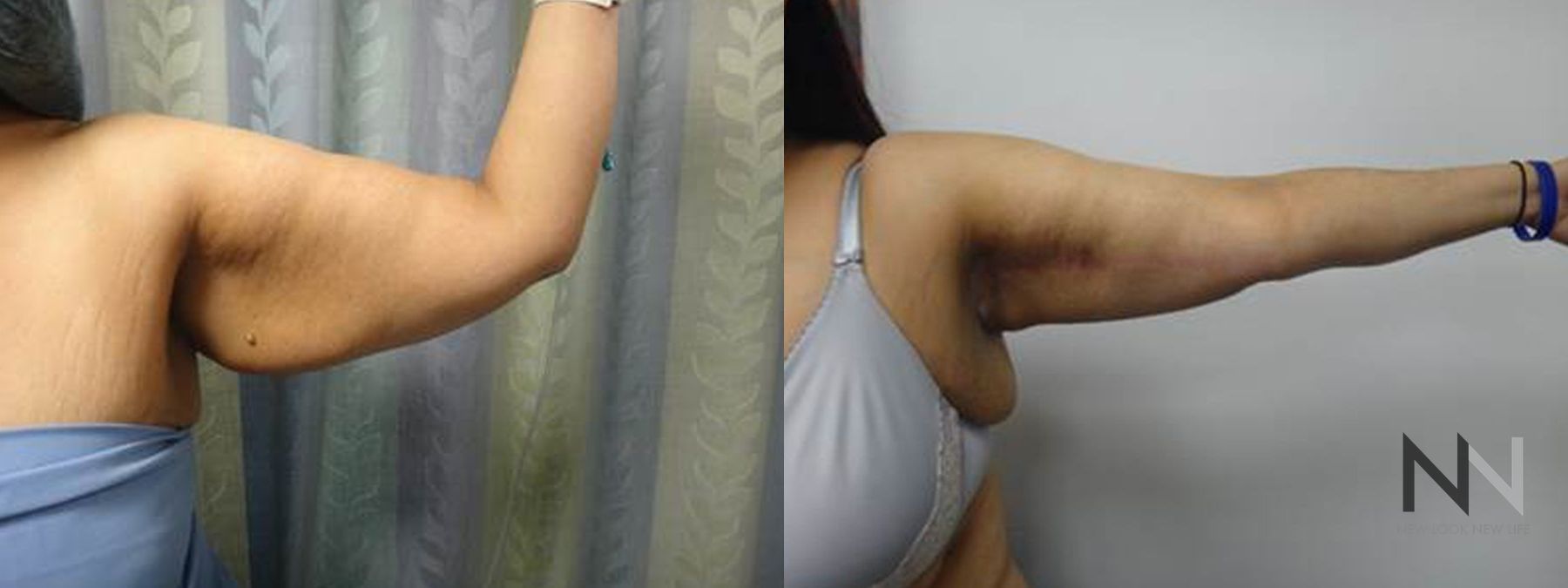 Brachioplasty results with smoother upper arm contour