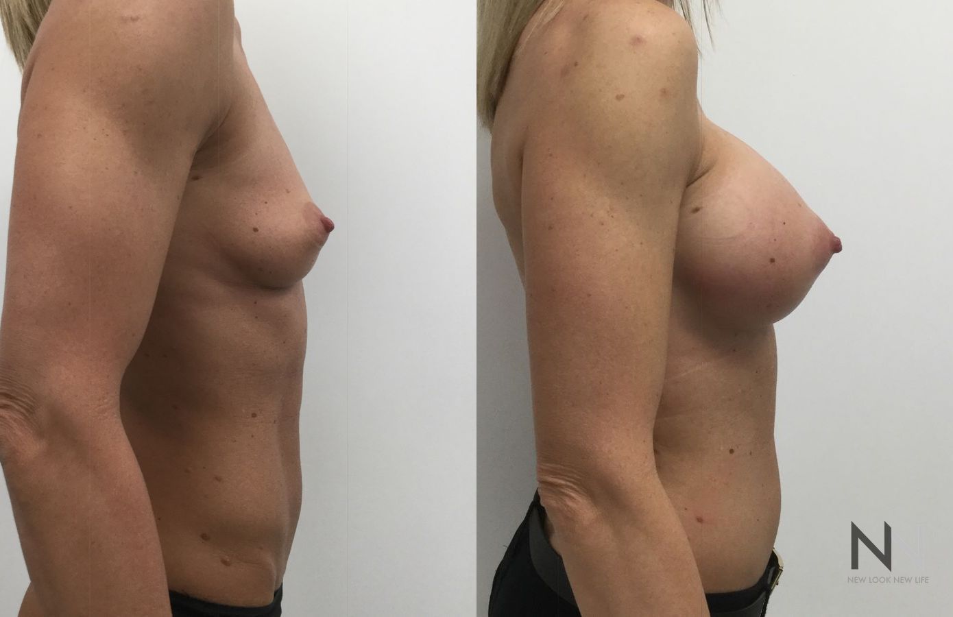 Breast implants showing increased volume and projection - Angle 3