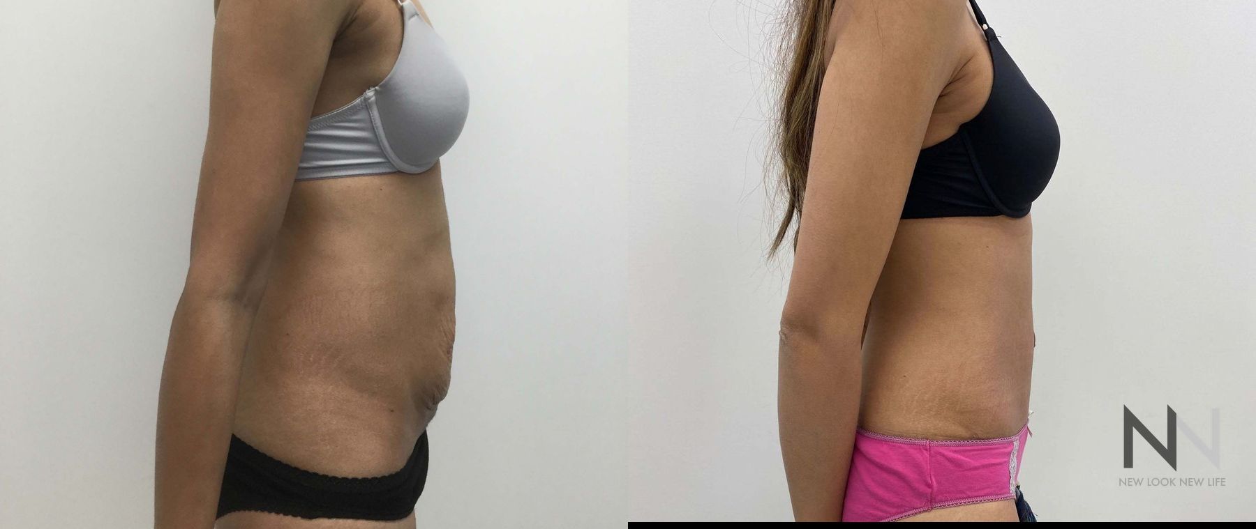 Before and after tummy tuck six months results - Angle 2
