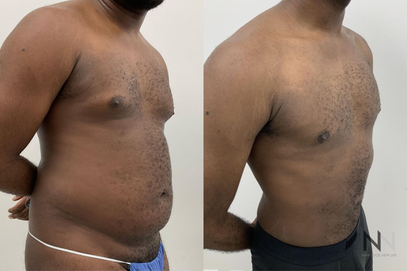 Body contouring with liposuction before and after - Angle 3