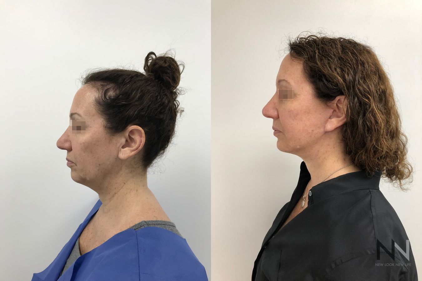 Mini facelift results six months post-op comparison - Angle 3