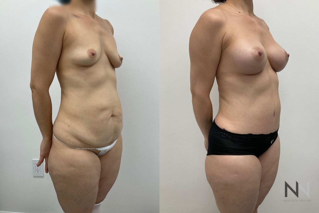 Breast augmentation and body contouring before and after - Angle 2