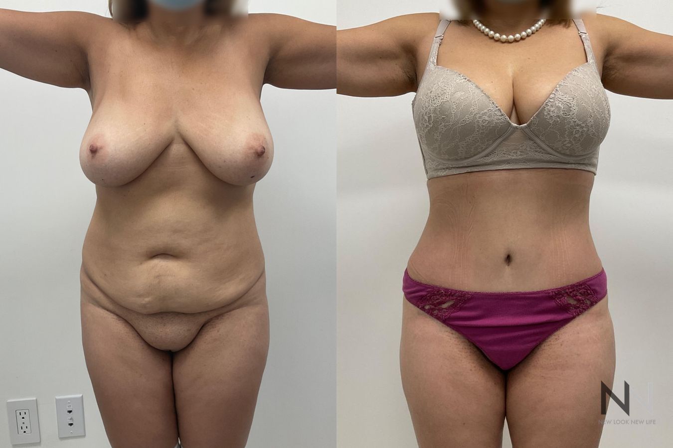 Abdominoplasty results showing improved abdominal contour